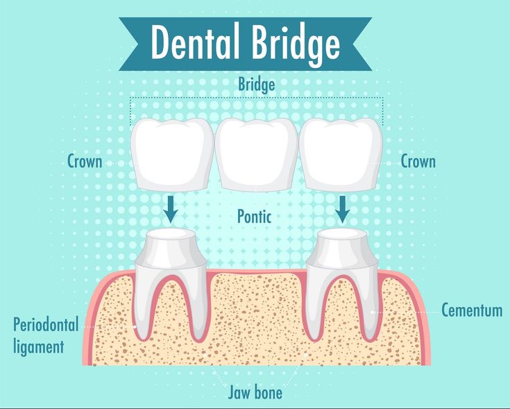 Cầu răng sứ là gì
